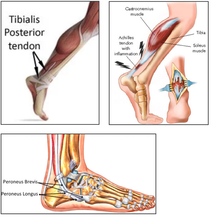 Achilles Tendon Medical Illustration